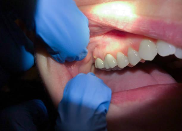 Best Emergency Root Canal Treatment in Silver Spring, MD